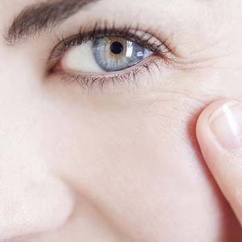 Model for Crow's Feet